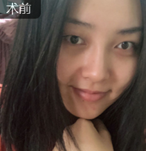 面部提升术