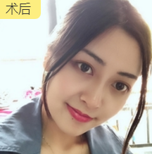 面部提升术