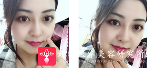 面部提升术