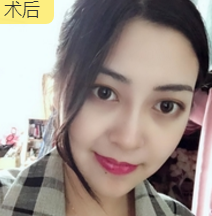 面部提升术