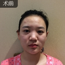 面部提升术