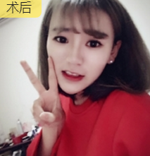 面部提升术