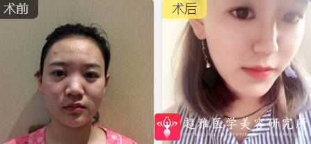 面部提升术