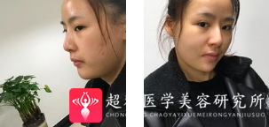 面部提升术