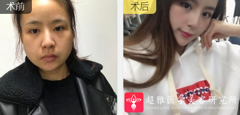 面部提升术