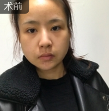 面部提升术