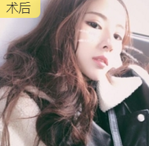 面部提升术