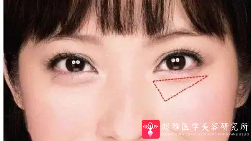 自体脂肪填充术