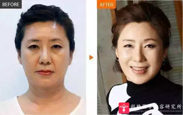 自体脂肪填充术