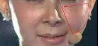 自体脂肪填充术
