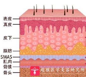 面部提升术