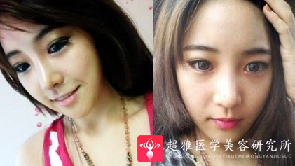 超声波瘦脸