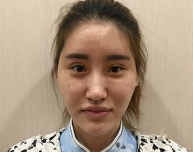 自体脂肪填充术