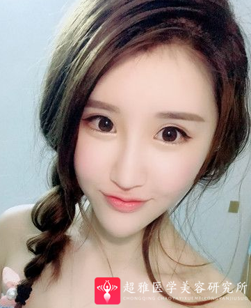 自体脂肪填充术