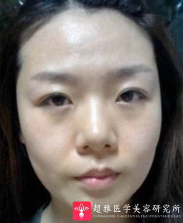 不开刀隆鼻