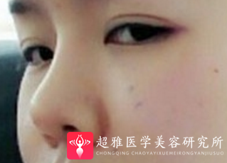 不开刀隆鼻