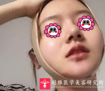 超声波瘦脸