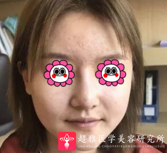 超声波瘦脸