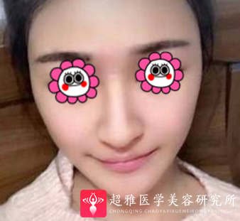 超声波瘦脸