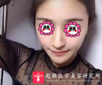 超声波瘦脸