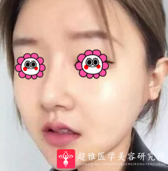 超声波瘦脸