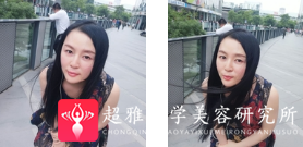 面部提升术