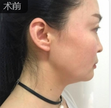 面部提升术