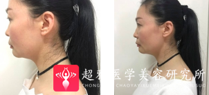 面部提升术