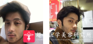 隆鼻手术
