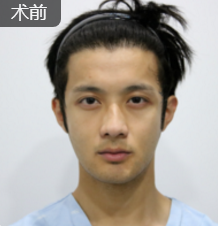隆鼻手术