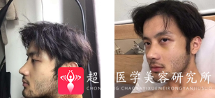 隆鼻手术