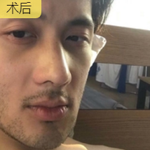 隆鼻手术