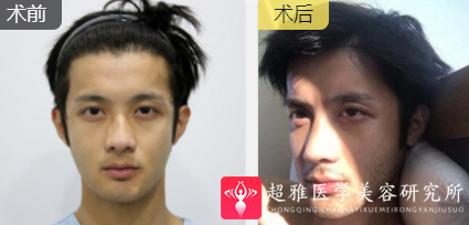 隆鼻手术