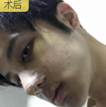 隆鼻手术