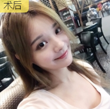 面部提升术