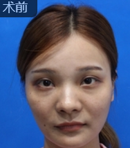 面部提升术