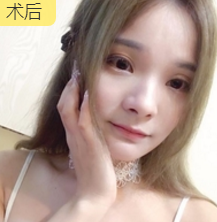 面部提升术