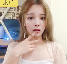 面部提升术