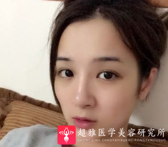自体脂肪填充术