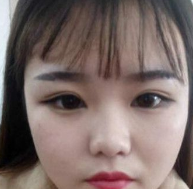不开刀隆鼻