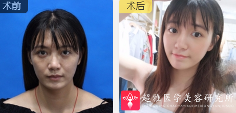 面部提升术