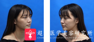 面部提升术