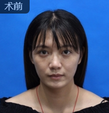 面部提升术