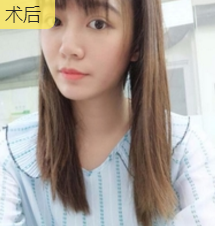 面部提升术