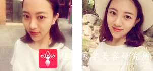 面部提升术