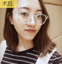 面部提升术