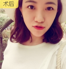 面部提升术
