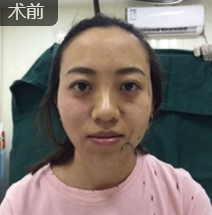 面部提升术