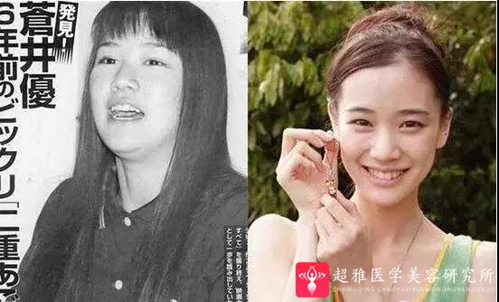 自体脂肪填充术