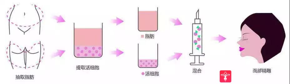 自体脂肪填充术